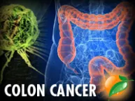 Colon Cancer